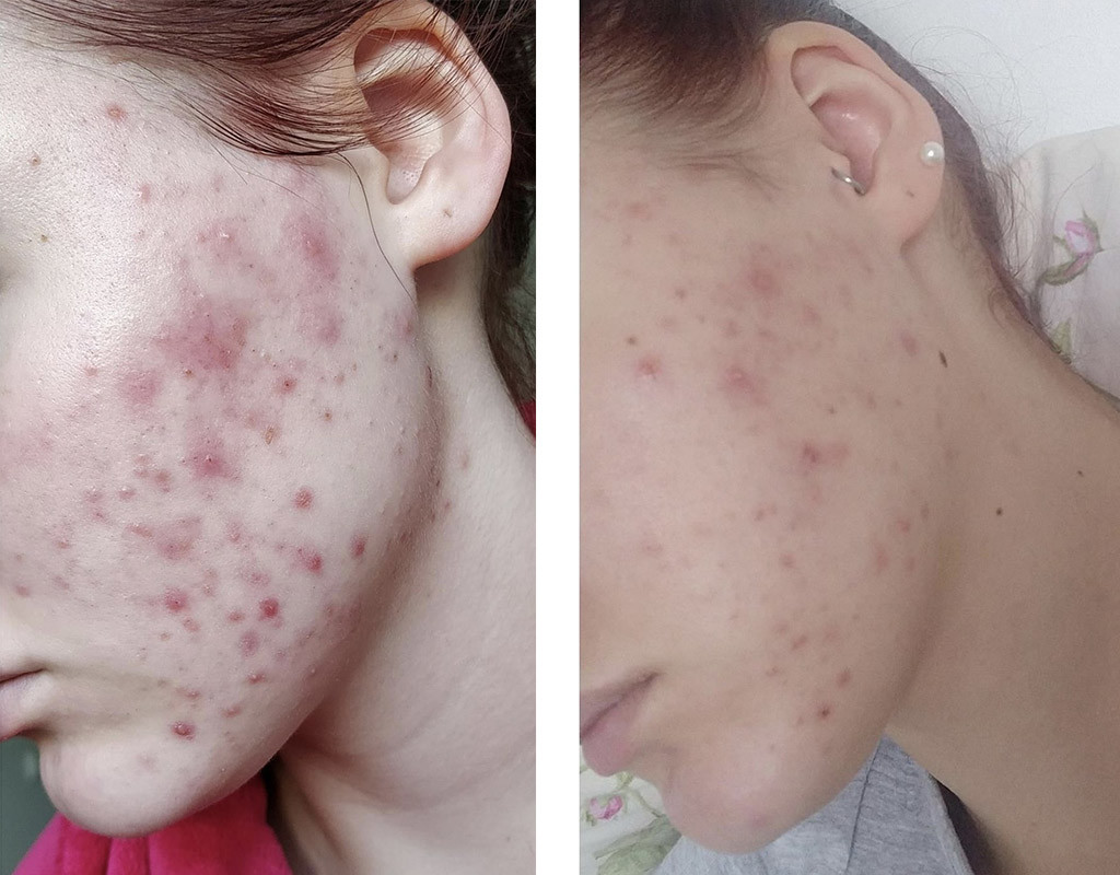 Before and after gua sha