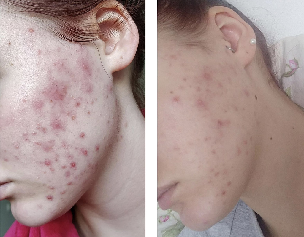 Gua sha for acne and rosacea Katja Kokko